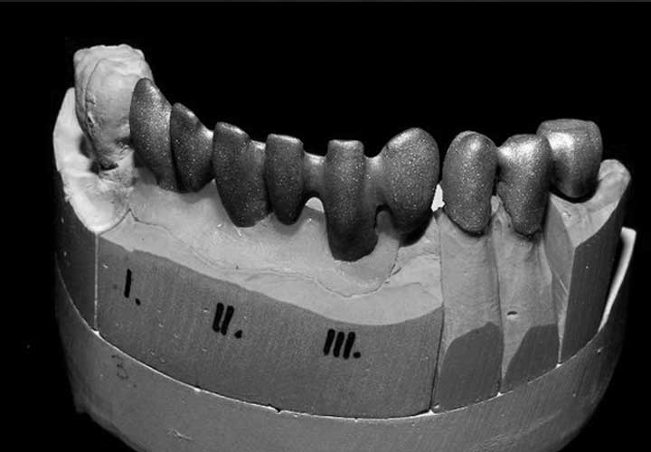Podbudowa metalowa pod ceramikę na implantach Ankylos CX oraz zębach pacjenta